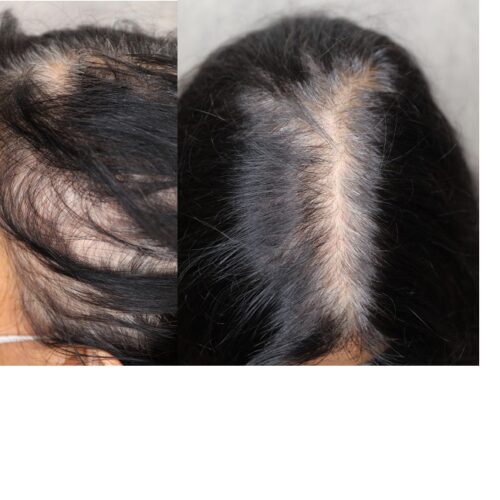 Hair loss Treatment Success Story MONARCH MD HAIR LAB MD