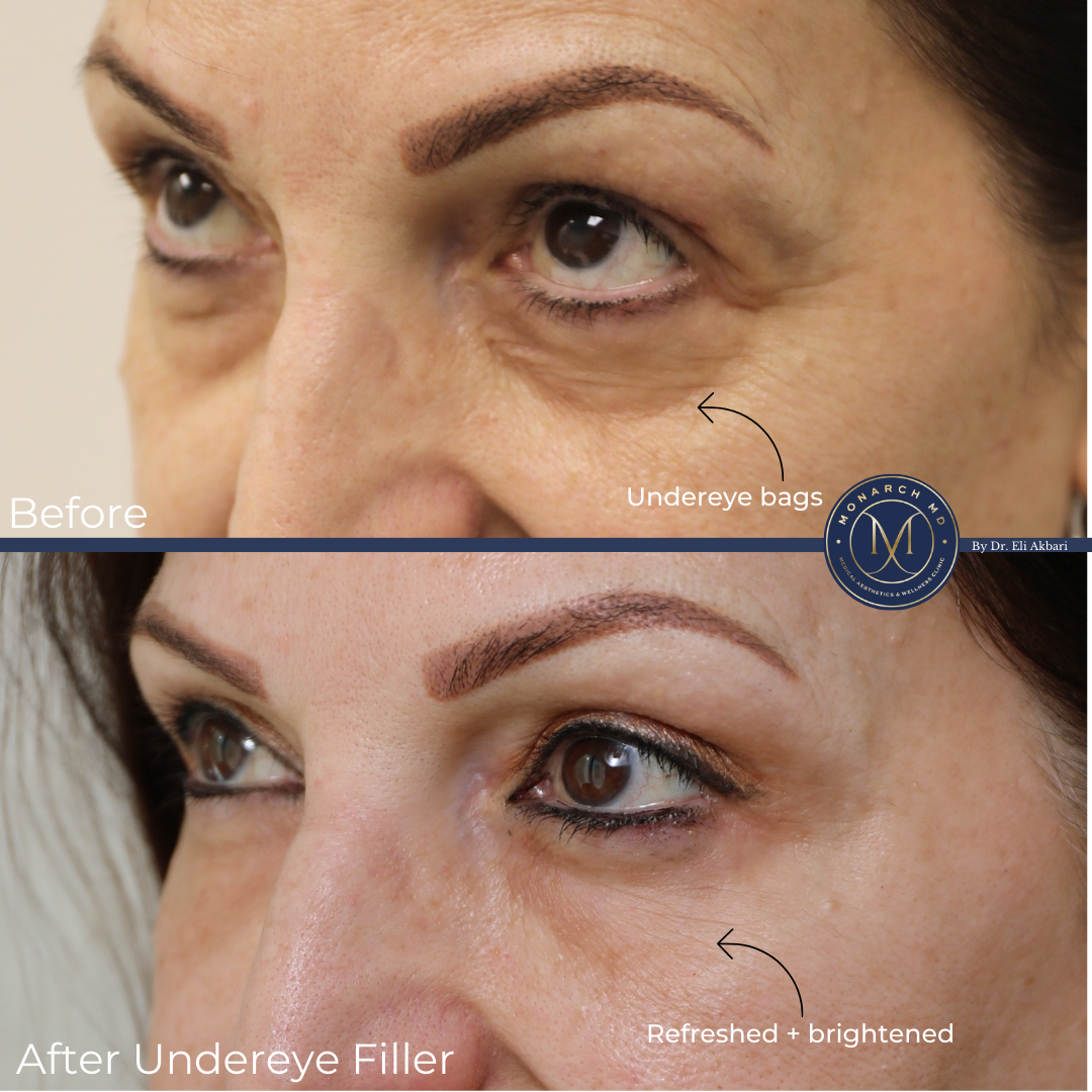 Undereye filler before and after