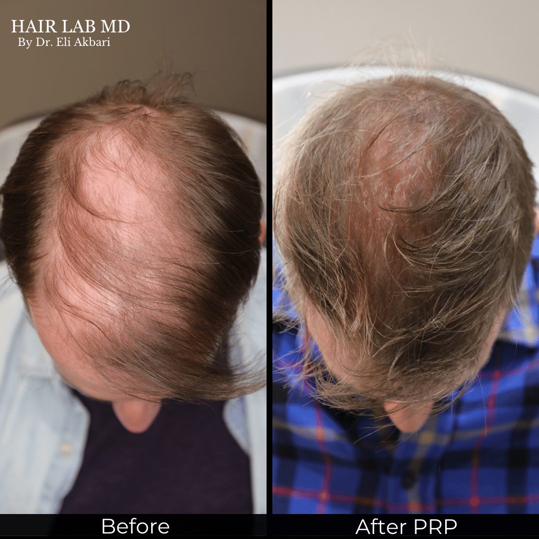 Hair density restoration result Monarch MD