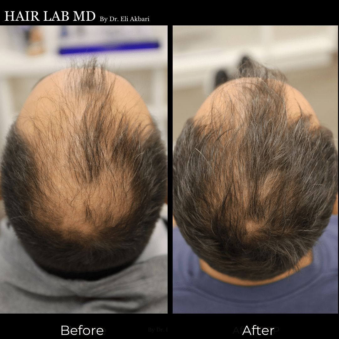 PRP hair restoration before and after Monarch MD