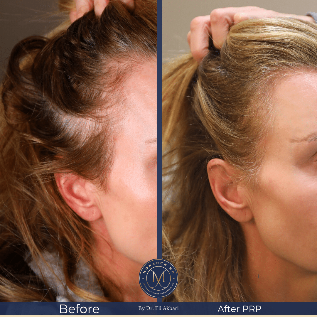 Hair regrowth result West Vancouver