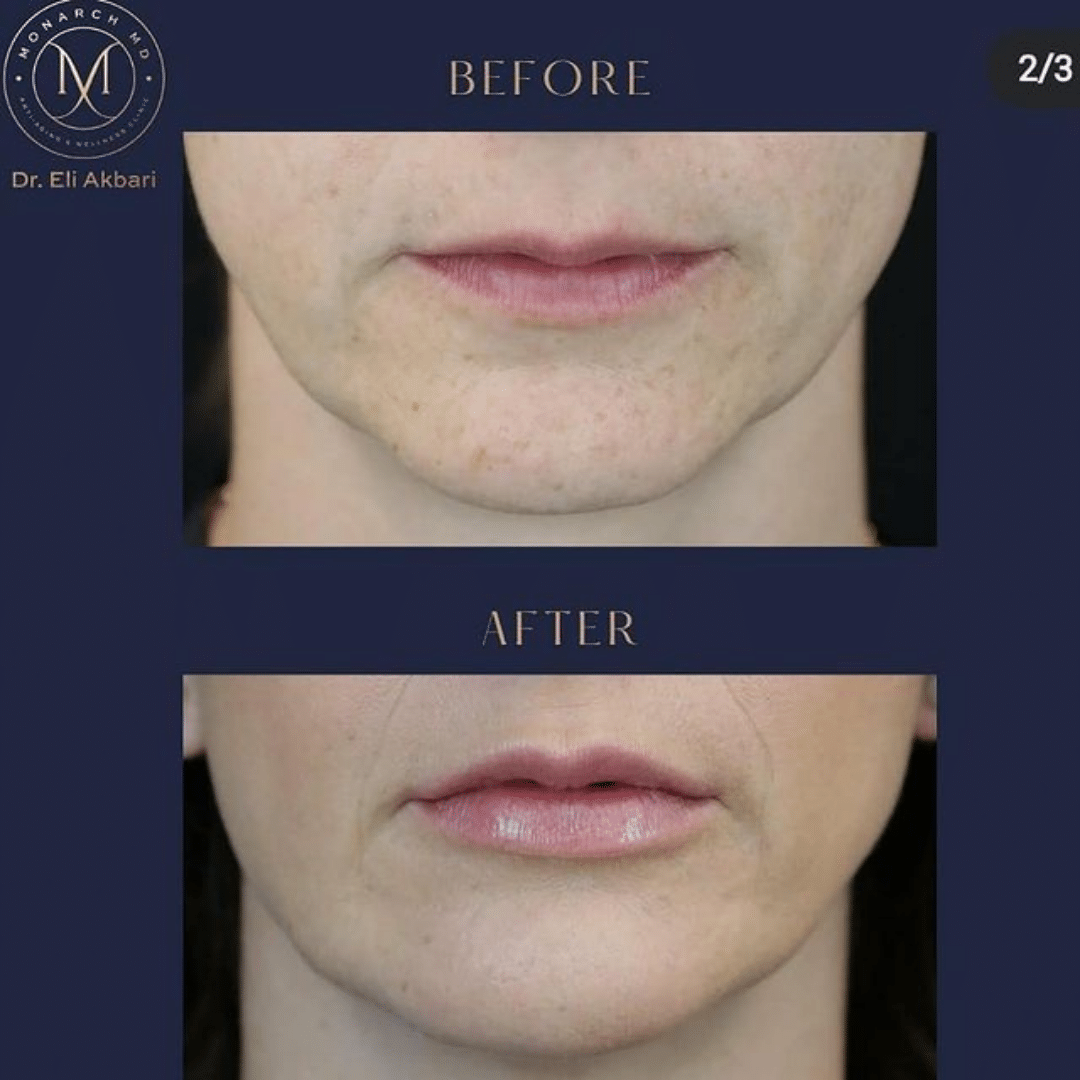 Lip filler before and after result 5 at Monarch MD West Vancouver