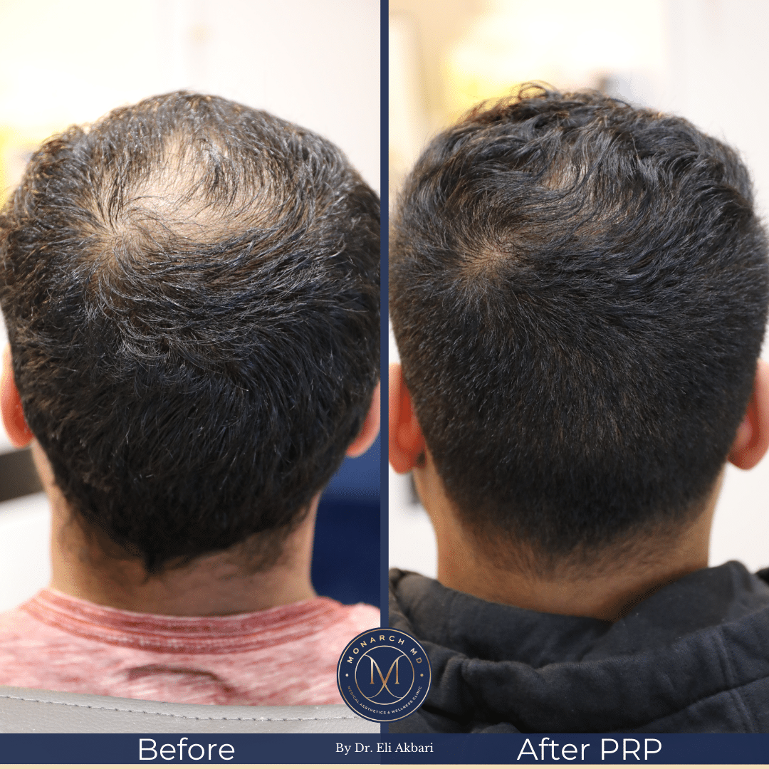 Hair restoration result at Monarch MD West Vancouver
