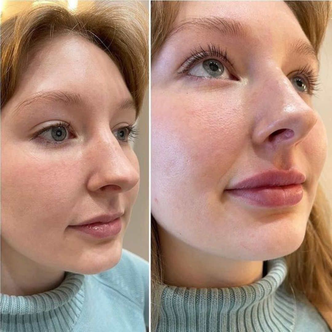 Filler results
