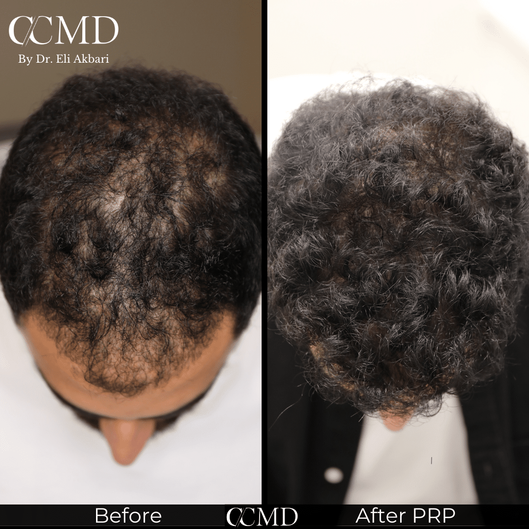 Hair density improvement after PRP treatment Monarch MD
