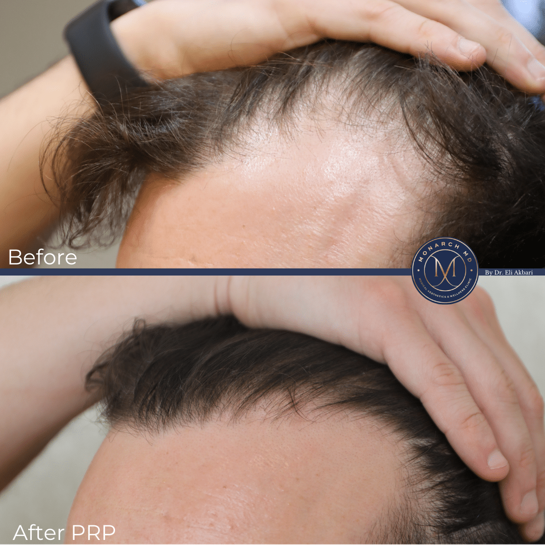 PRP hair treatment result West Vancouver