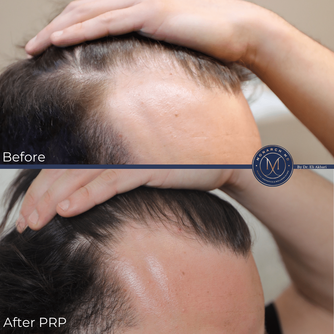 Hair loss treatment result Monarch MD