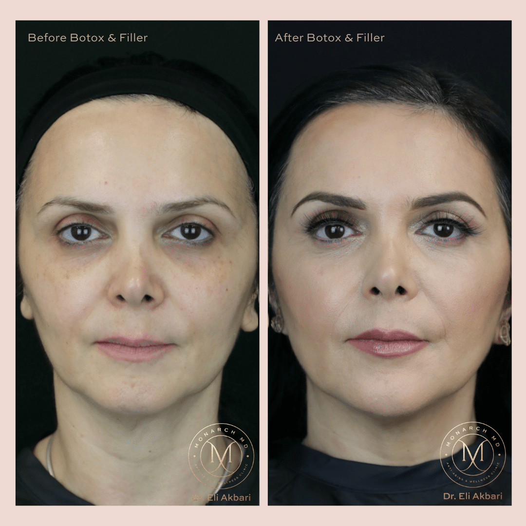 Lip filler before and after result 6 at Monarch MD West Vancouver