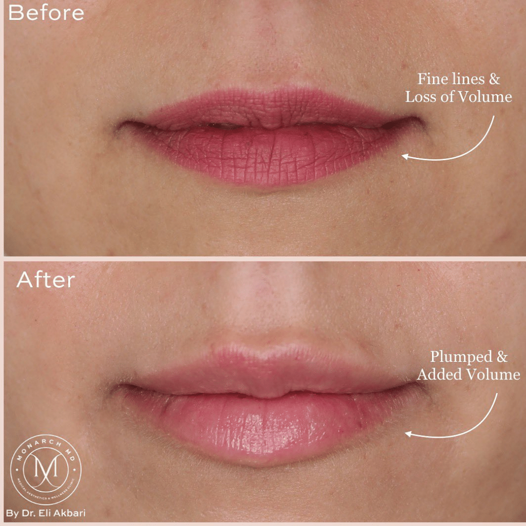 Lip filler before and after result 3 at Monarch MD West Vancouver