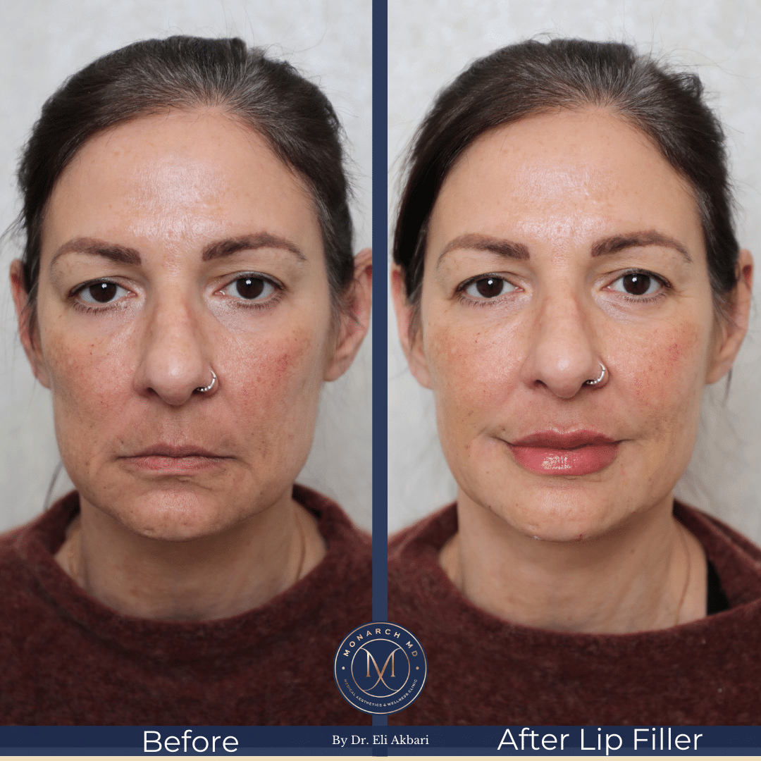 Lip filler before and after result 4 at Monarch MD West Vancouver