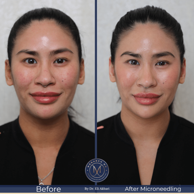 Microneedling before and after — acne scar and pore refinement