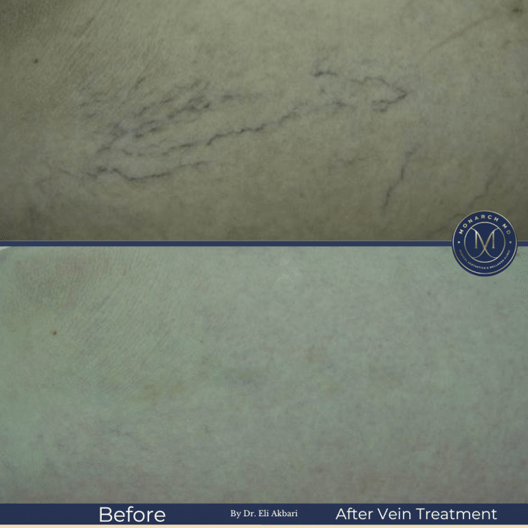 IPL before and after — acne scarring and discoloration