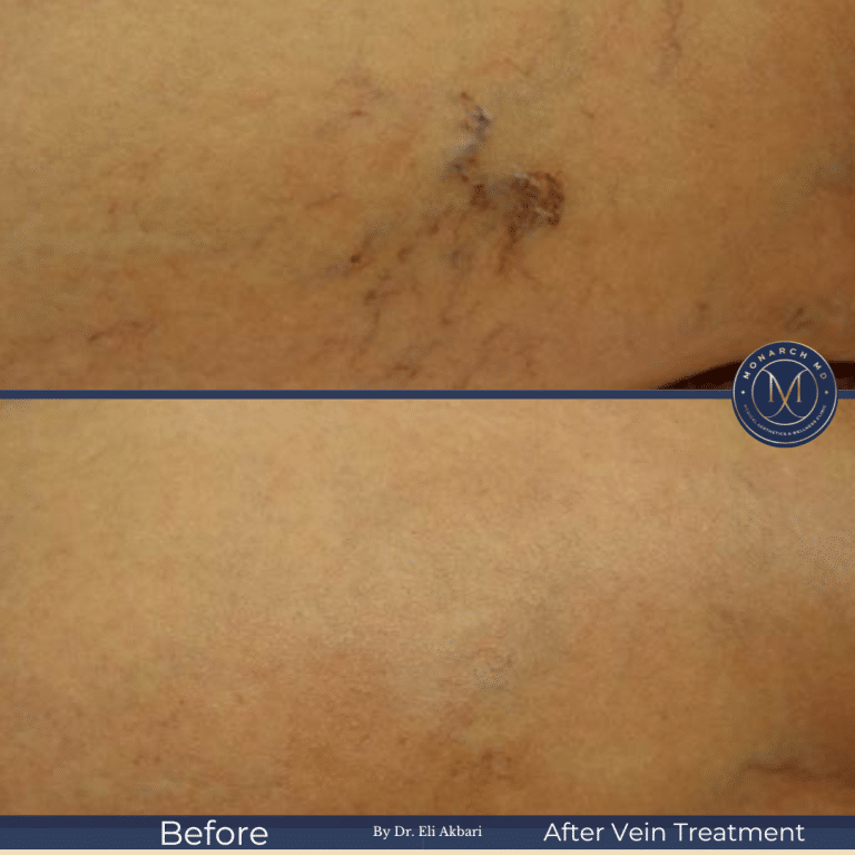 IPL before and after — sunspot and pigmentation clearance