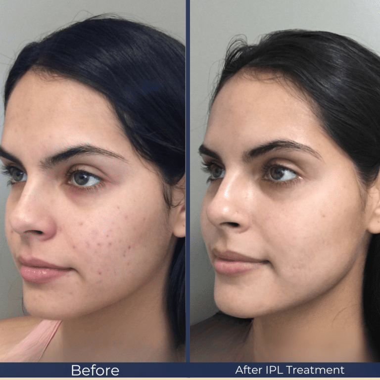 IPL before and after — redness and vascular lesion treatment