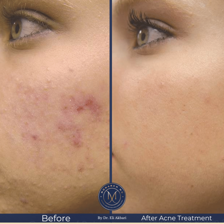 IPL before and after — uneven skin tone improvement