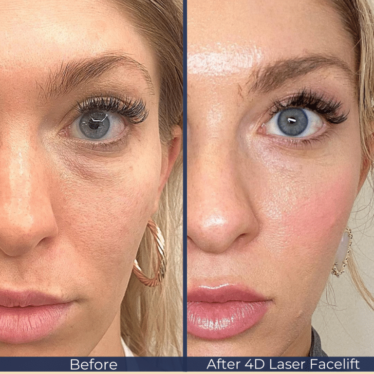 Fotona 4D before and after jawline definition and skin texture