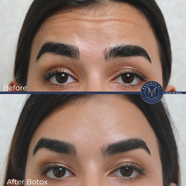 Botox treatment results