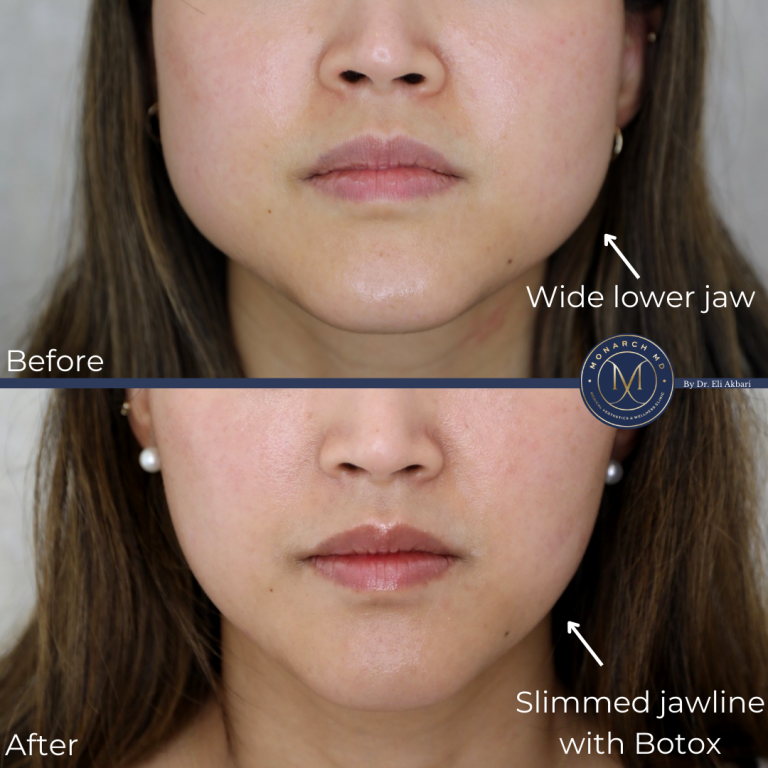 Botox crow's feet before and after