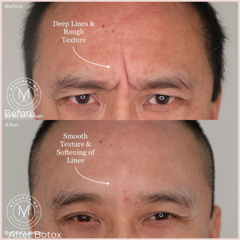 Botox frown lines before and after