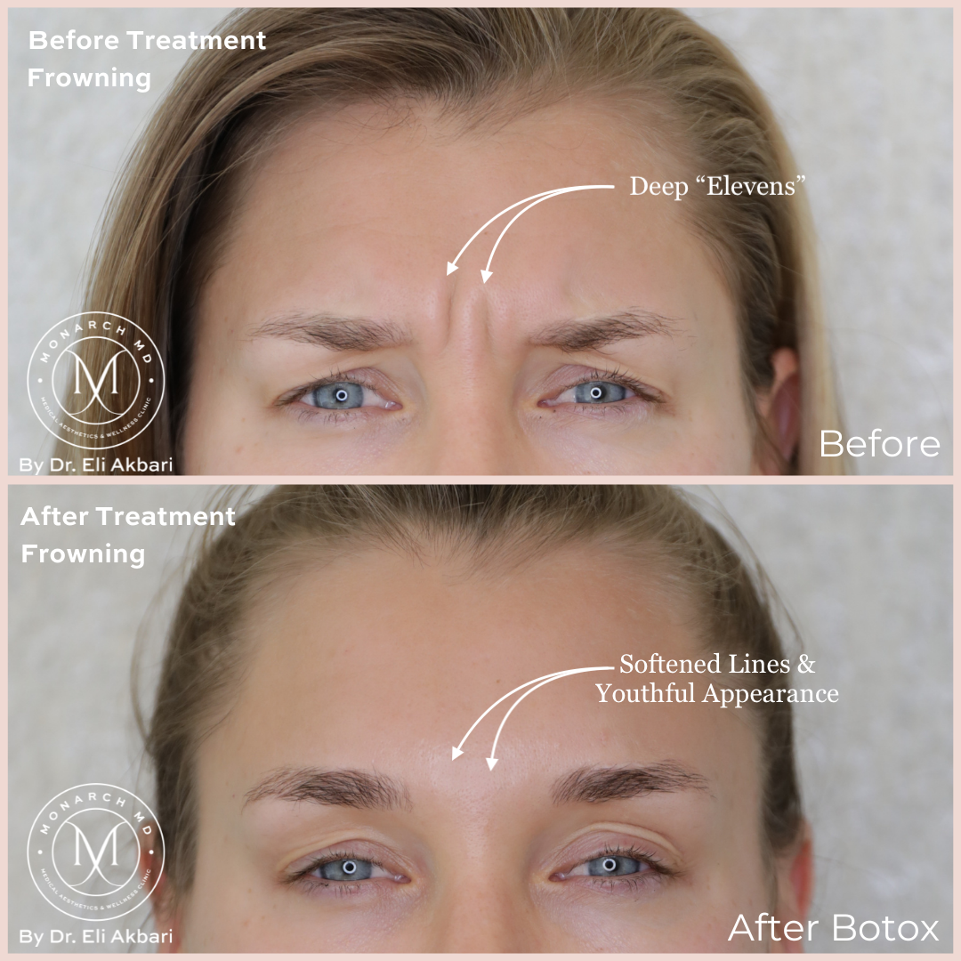 Botox before and after