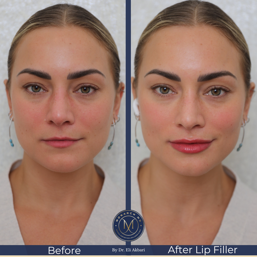 Lip filler before and after