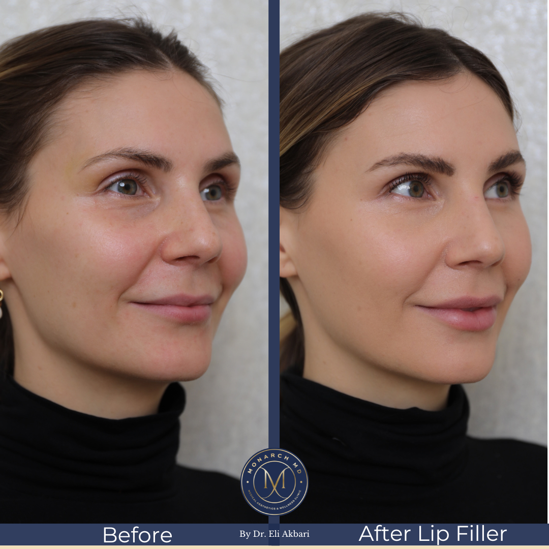 Dermal filler before and after