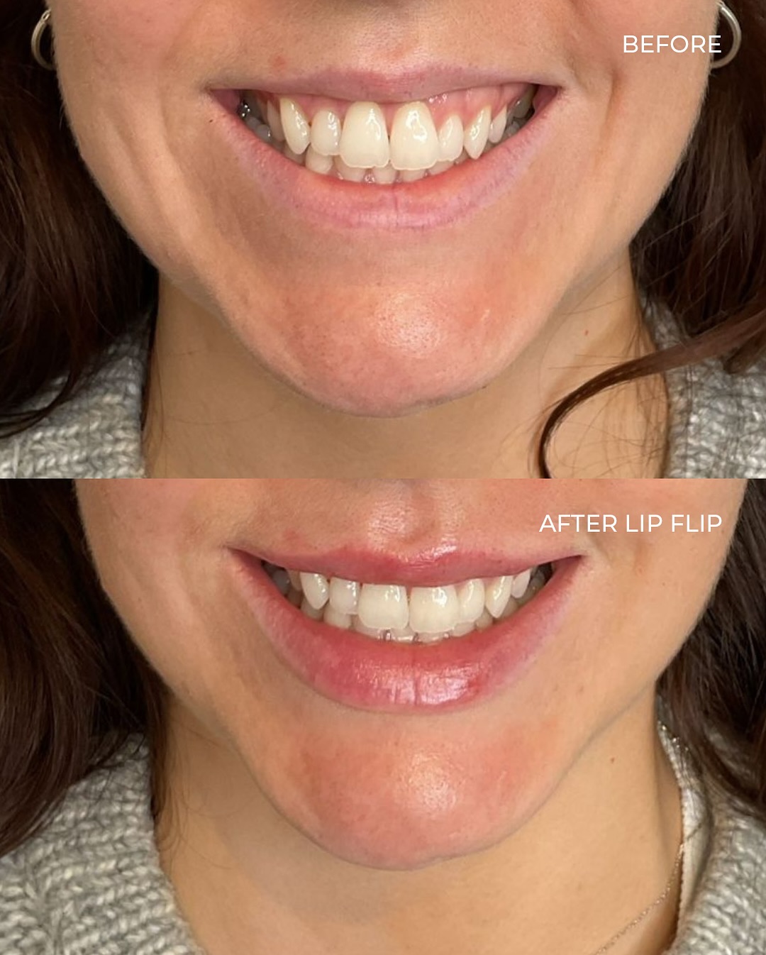 Lip flip before and after — upper lip enhancement