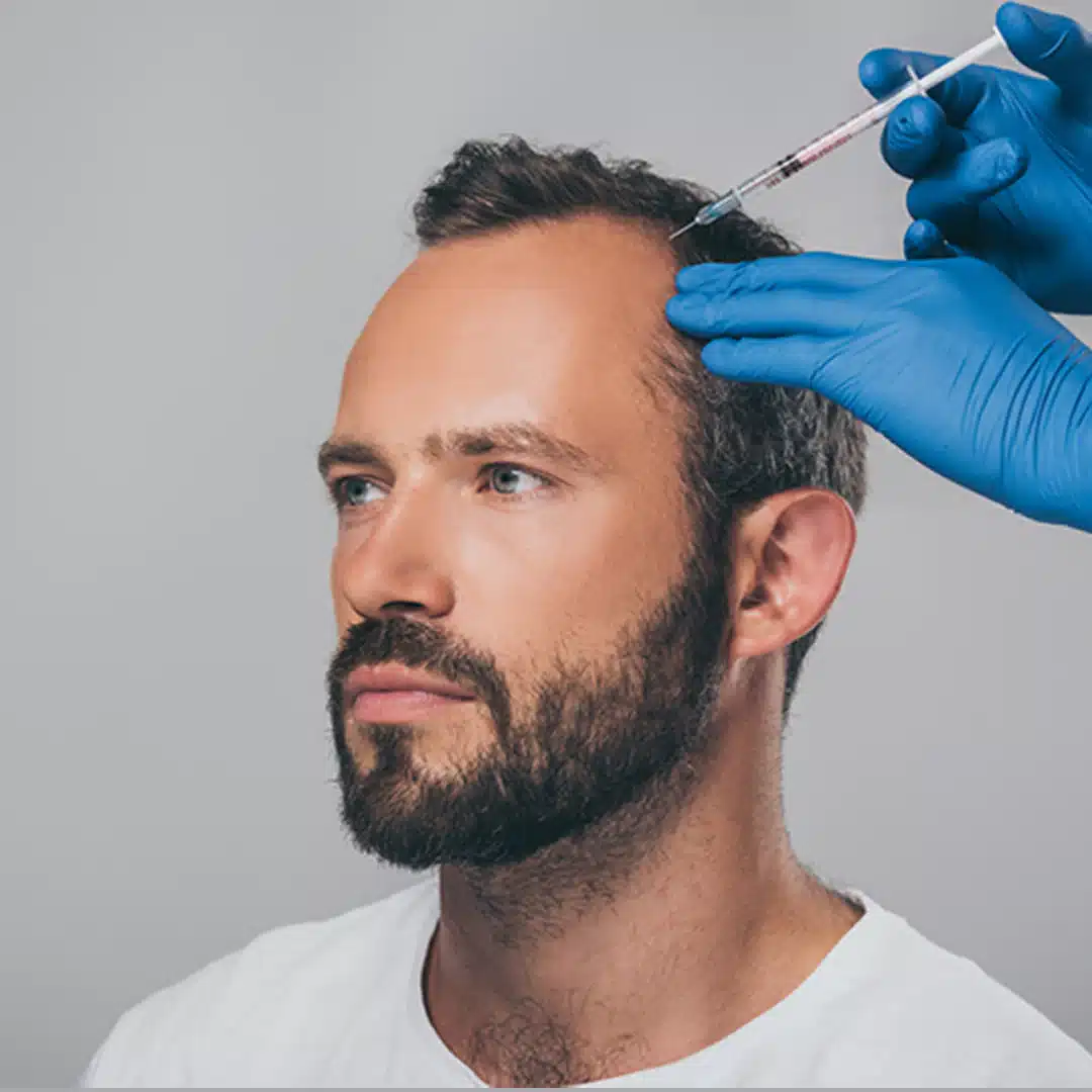 Physician performing scalp mesotherapy injection for hair loss