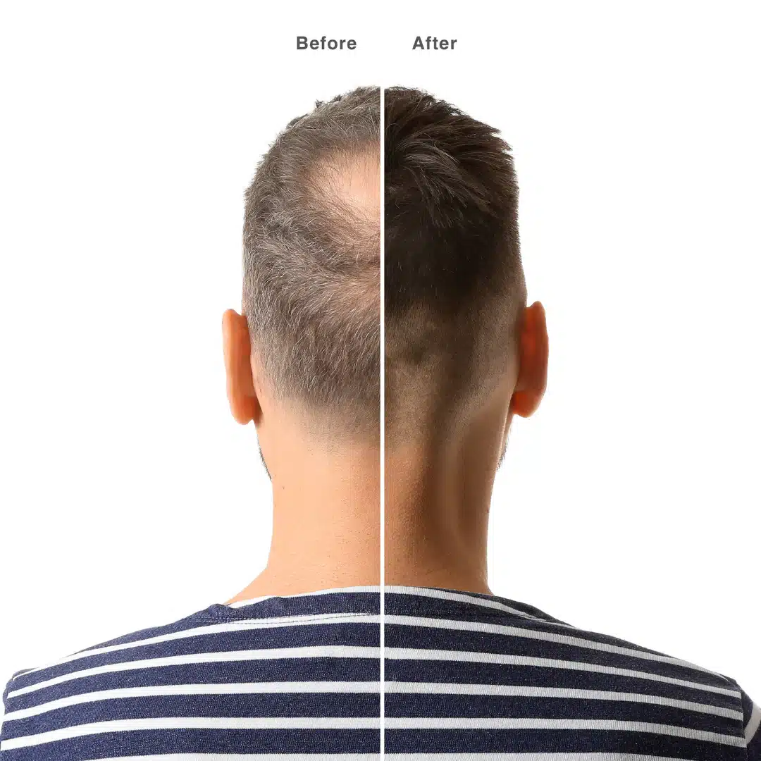 Scalp injection procedure for androgenetic alopecia at Monarch MD