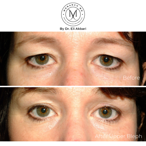bleph eye lid vancouver