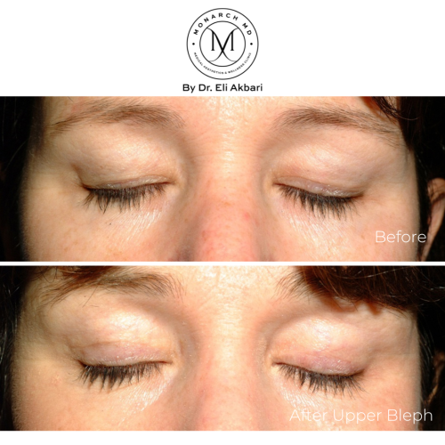 Double eye-lid surgery vancouver