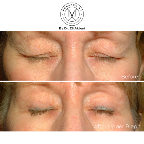 eye-lid reduction surgery Vancouver