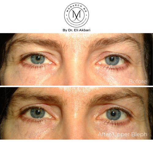 tired eyes droopy eye-lids surgery