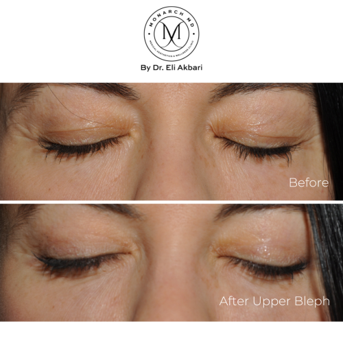 before and after blepharoplasty