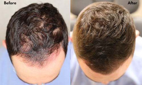 Men hair-loss treatment