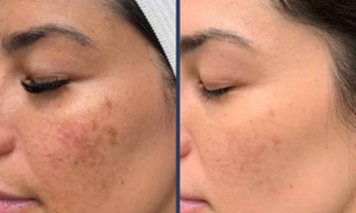 Chemical peel treatment results before and after 1