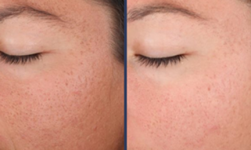 Chemical peel treatment results before and after 2