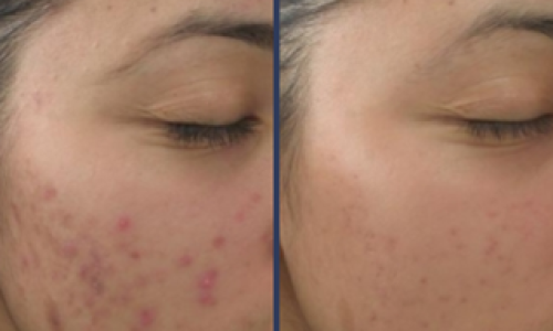 Chemical peel treatment results before and after 3