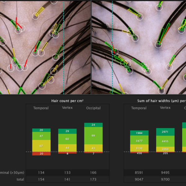 hair analysis for hair prp, vancovuer's best hair prp