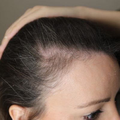 Image of patient suffering from post-COVID hair-loss Image of patient suffering from post-COVID hair-loss