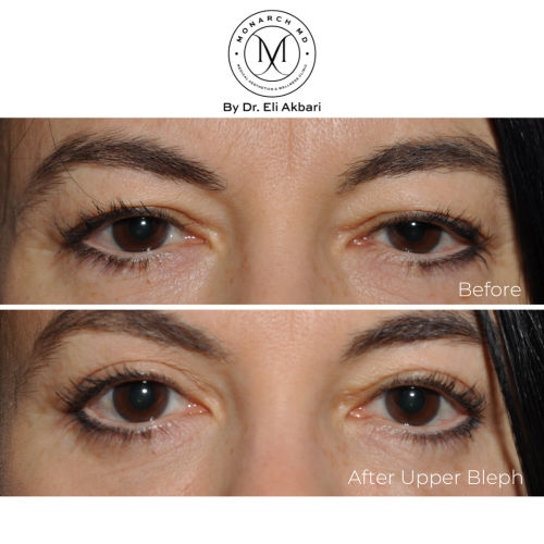 eye-lid surgery pricing