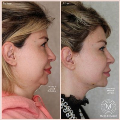 double chin clinic vancouver double chin clinic vancouver