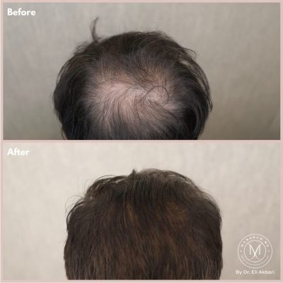 hair-loss before and after hair-loss before and after