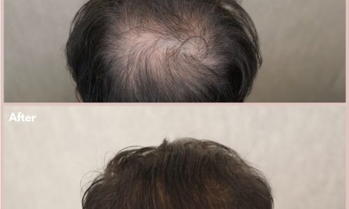 hair-loss before and after