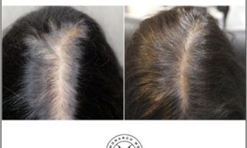 Hair-loss treatment results with PRP