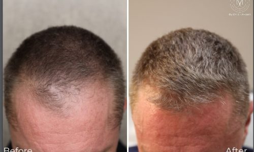 hairloss treatment before and after