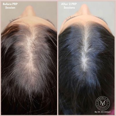 prp before and after prp before and after