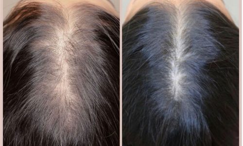 prp before and after